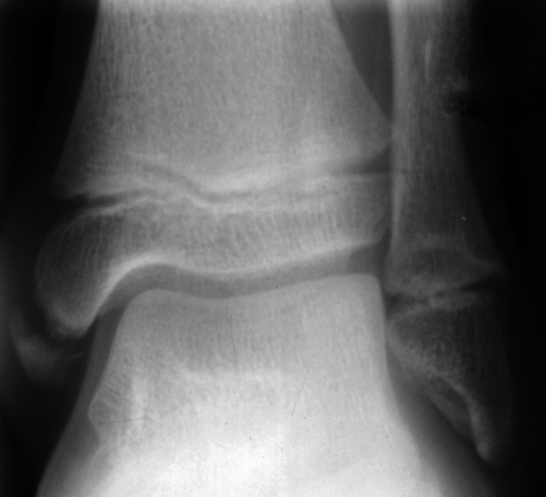 Osteochondrosis juvenilis of the medial malleolar epiphysis | Bone & Joint