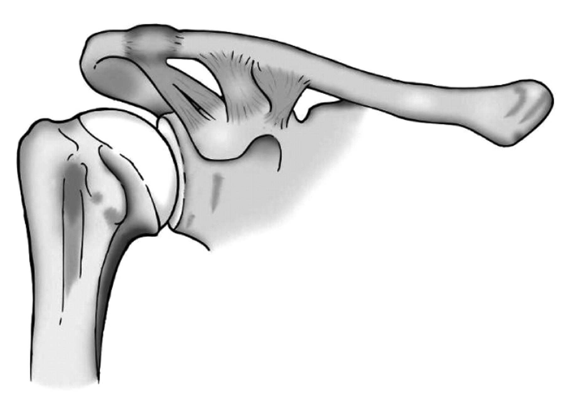 Injuries To The Acromioclavicular Joint Bone And Joint