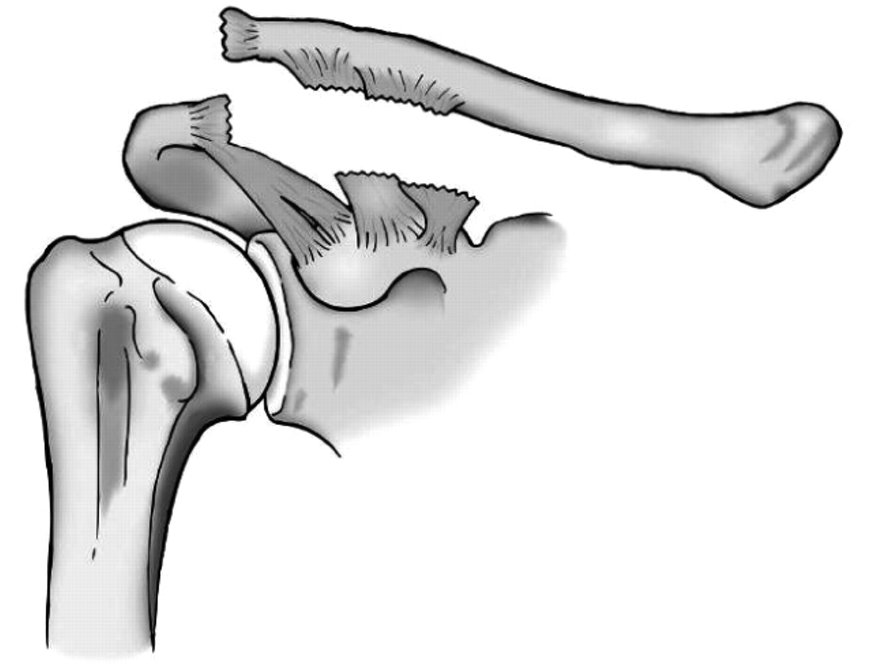 Injuries To The Acromioclavicular Joint Bone And Joint