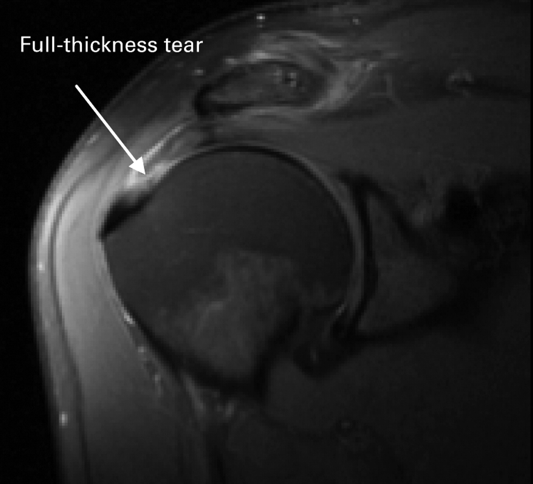 The pathogenesis and surgical treatment of tears of the rotator cuff ...