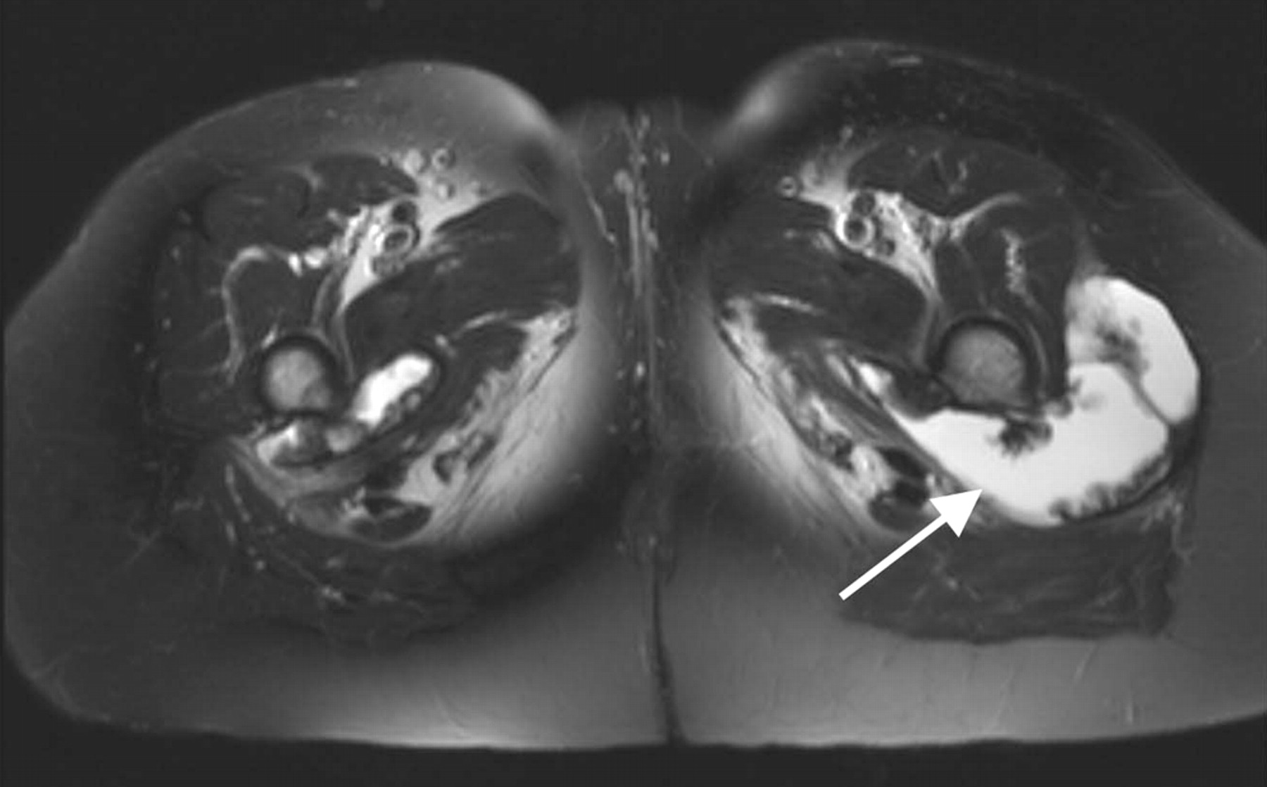 Pseudotumours associated with metal-on-metal hip resurfacings | Bone ...