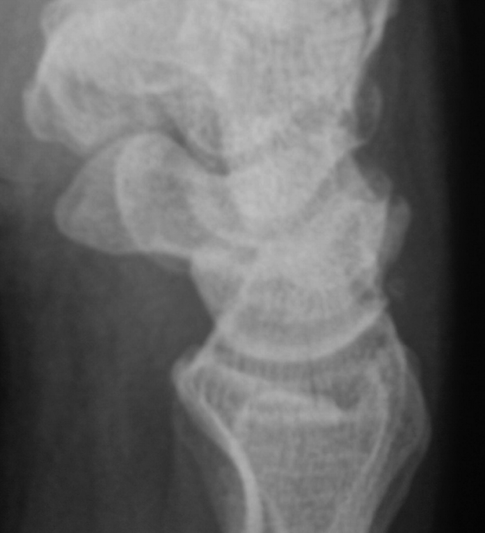 Clinical and radiological outcome of cast immobilisation versus ...