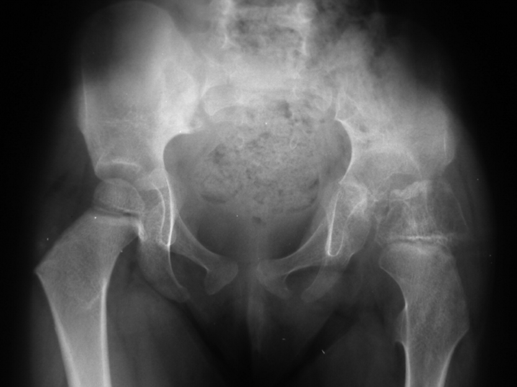 Dysplasia epiphysealis hemimelica with involvement of the hip and spine ...