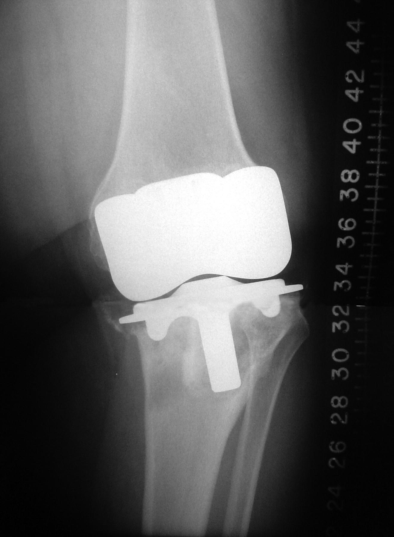 The Management Of Bone Loss In Revision Total Knee Replacement 