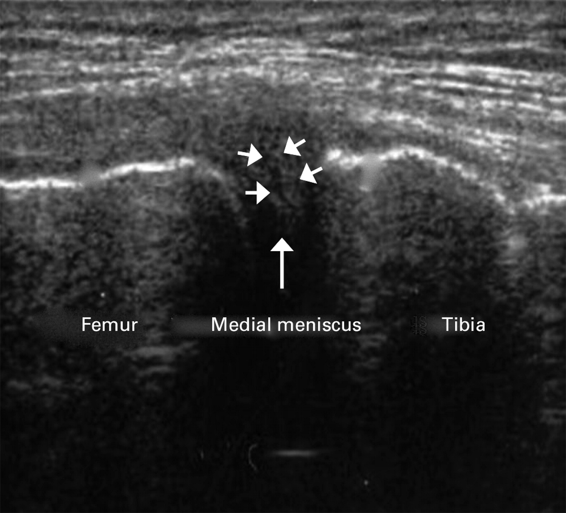 Can You See Meniscus On Ultrasound