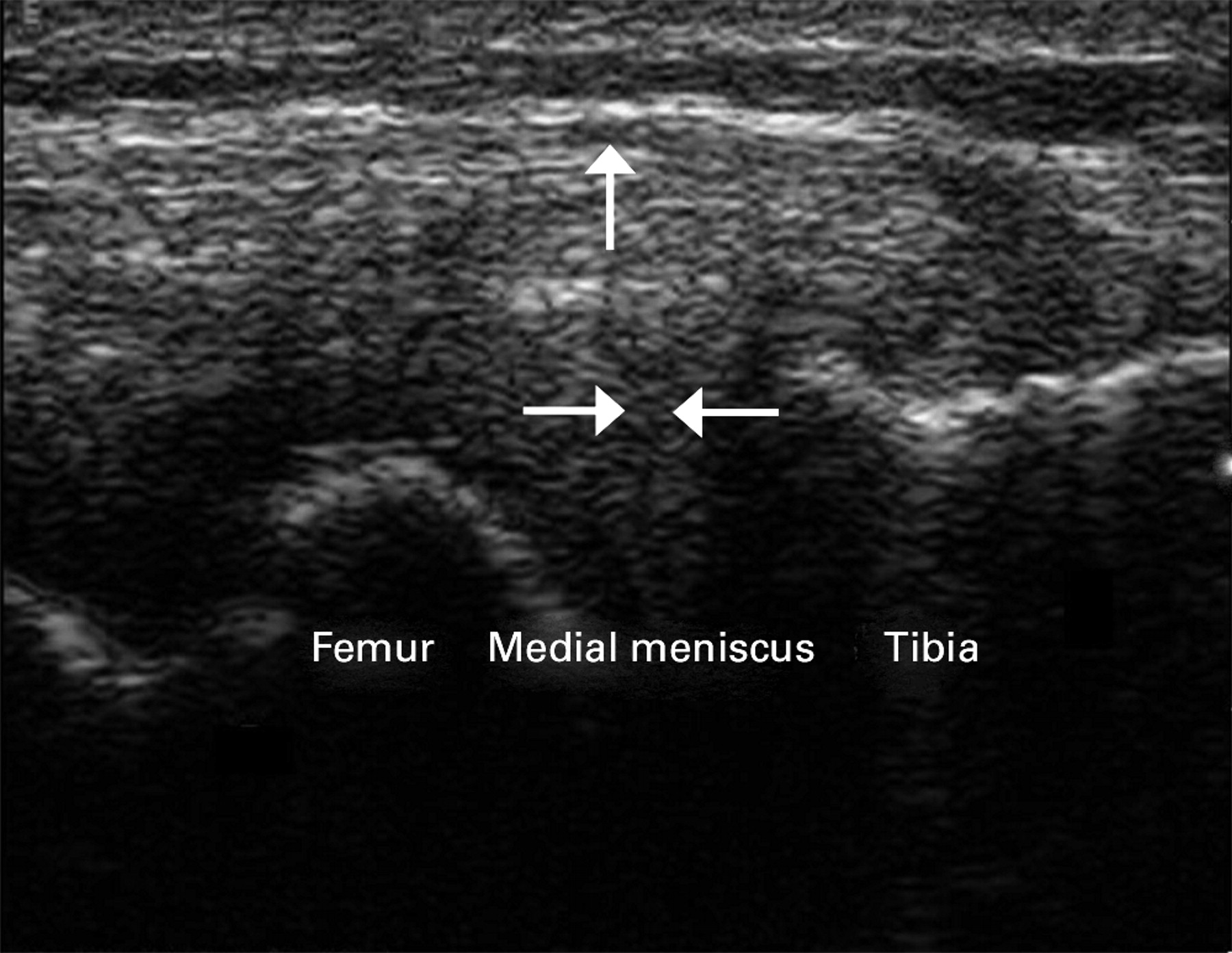 Accuracy of hand-held ultrasound scanning in detecting meniscal tears ...