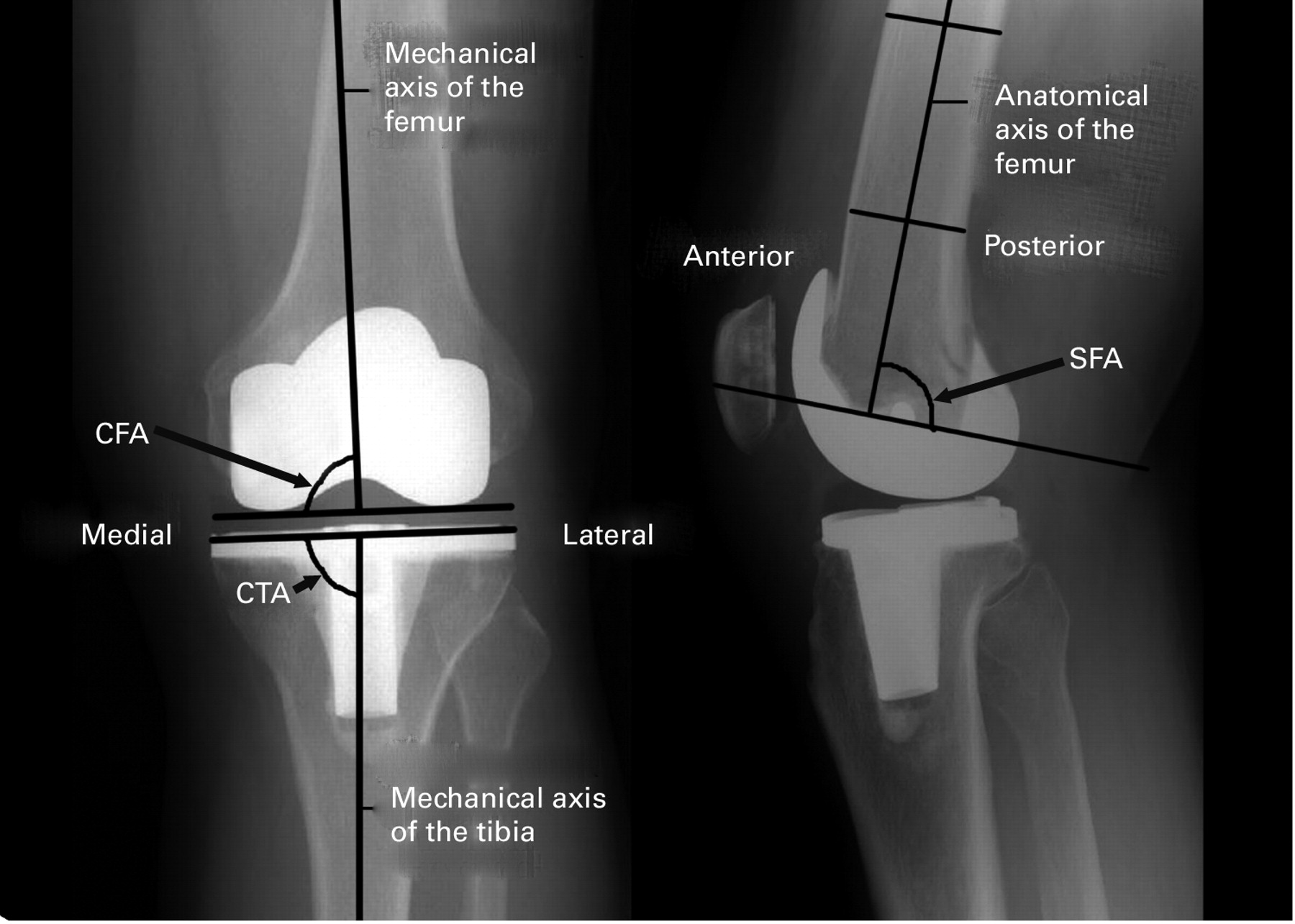 Femoral And Tibial Tunnel Cysts Coronal Stir Sequence - vrogue.co