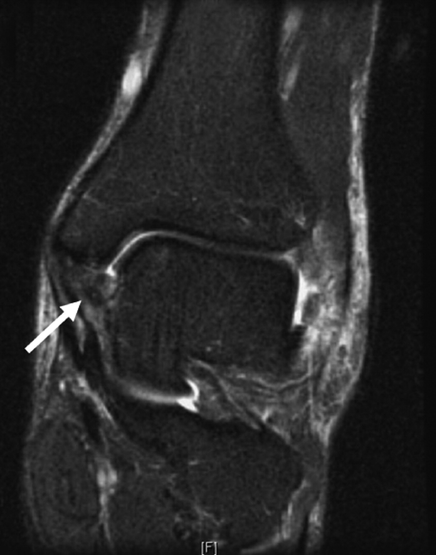 Ossicles Associated With Chronic Pain Around The Malleoli Of The Ankle 