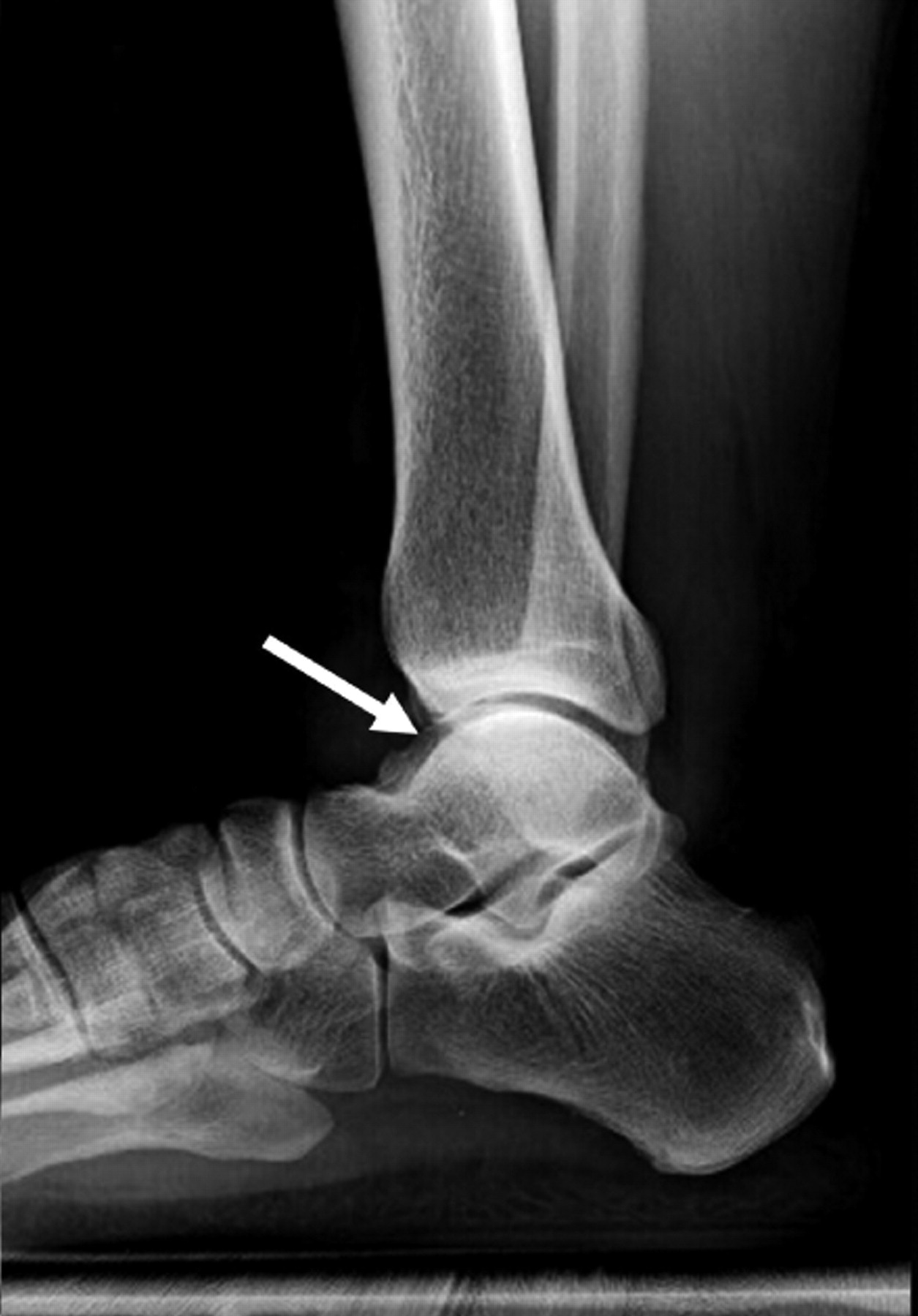 Ossicles Associated With Chronic Pain Around The Malleoli Of The Ankle 