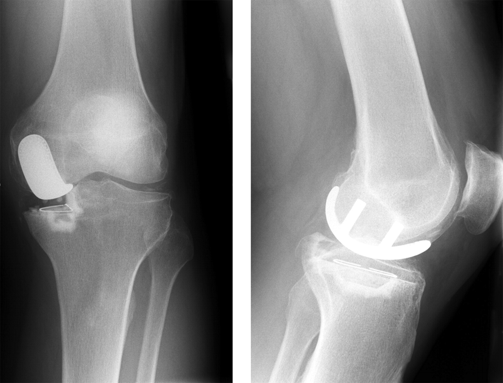 Unicompartmental Or Total Knee Replacement 