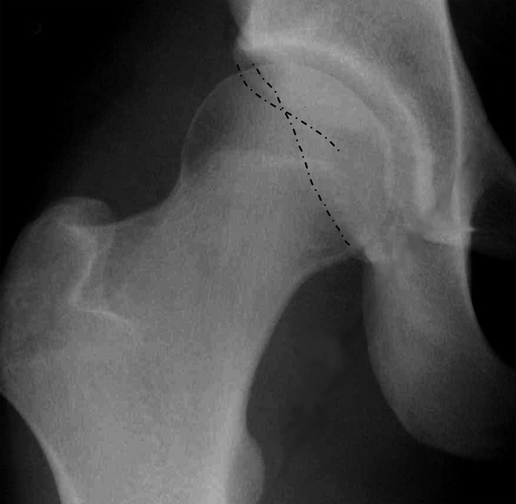 Outcomes following hip arthroscopy for femoroacetabular impingement ...