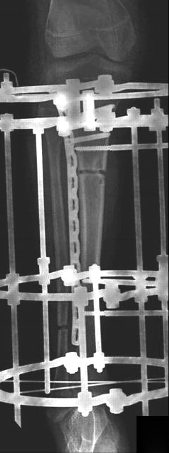 Limb Lengthening With A Submuscular Locking Plate | Bone & Joint