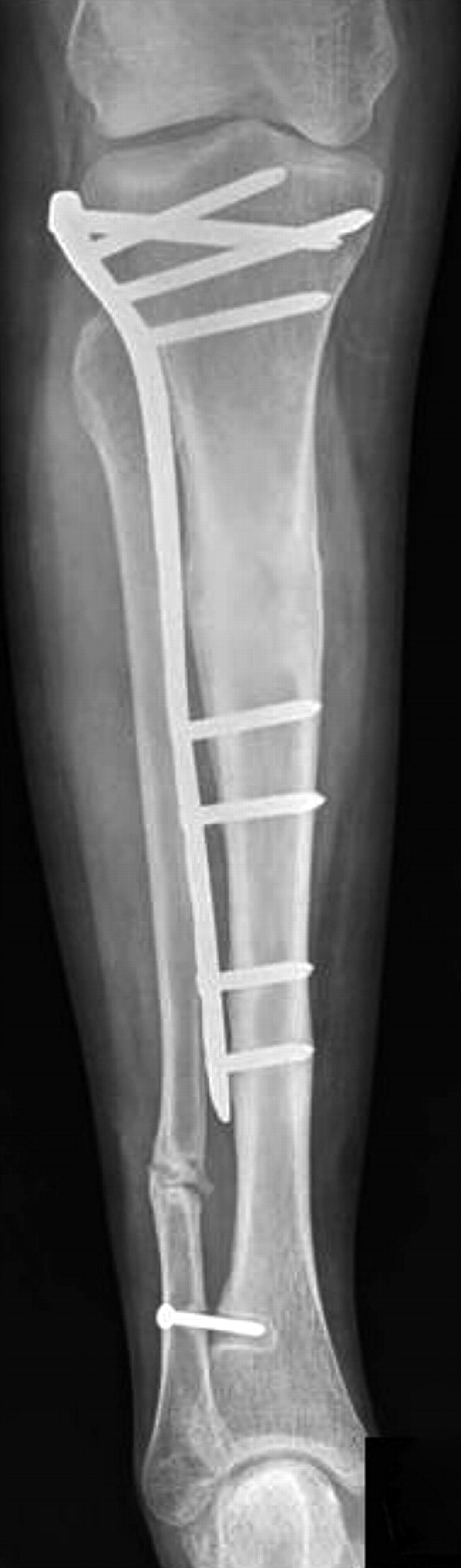 Limb lengthening with a submuscular locking plate | Bone & Joint