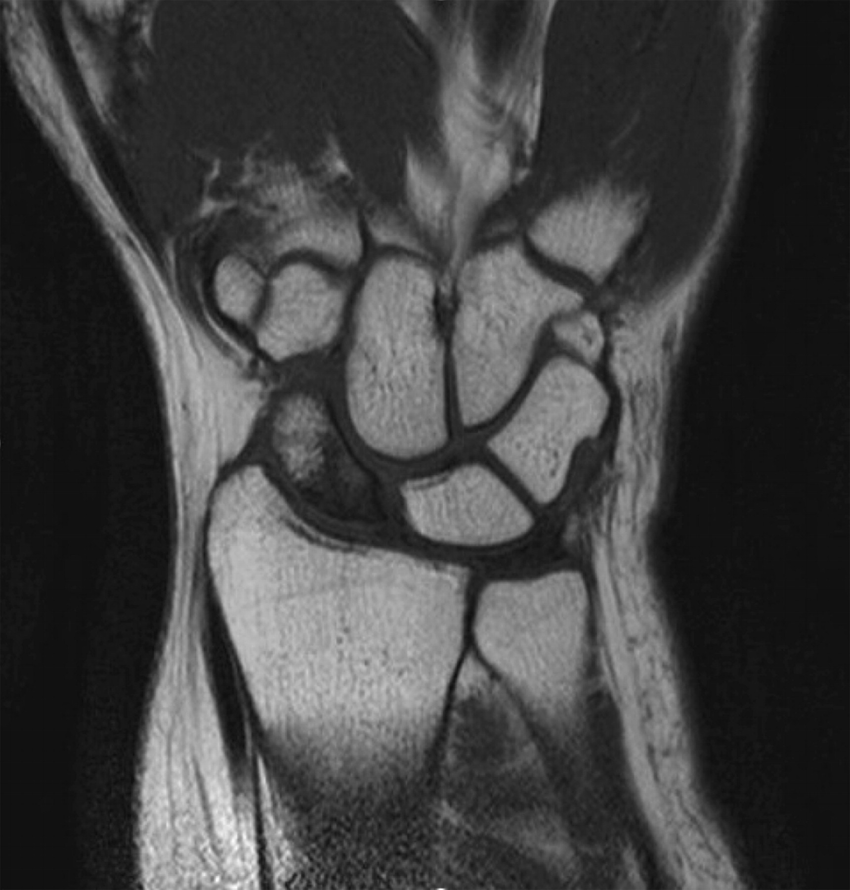 Bilateral idiopathic avascular necrosis of the scaphoid | Bone & Joint