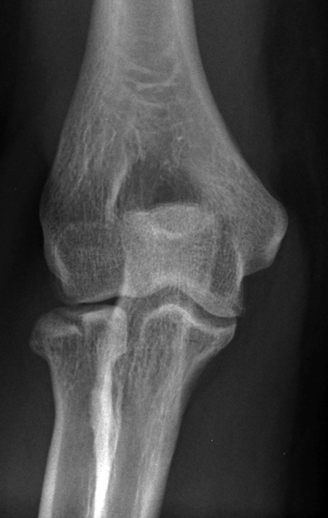 Osteotomy of the head of the radius for partial articular malunion ...