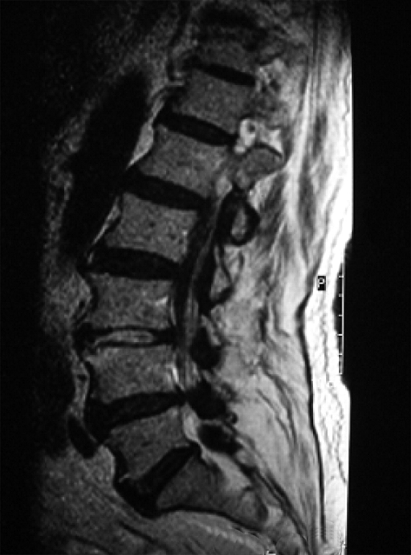 Late spinal subdural haematoma after spinal anaesthesia for total hip ...