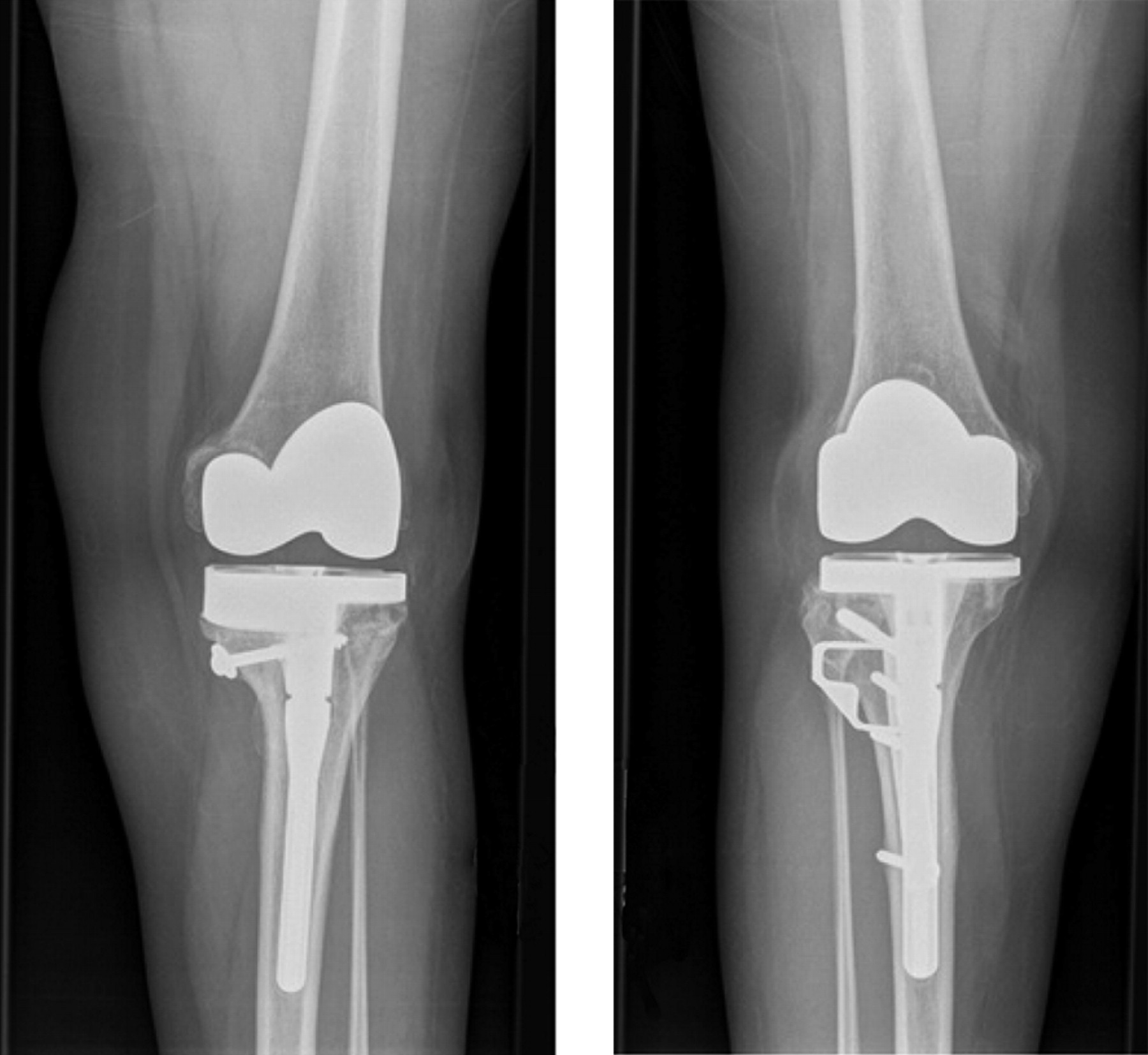 Total knee replacement with rotational proximal tibial osteotomy for ...