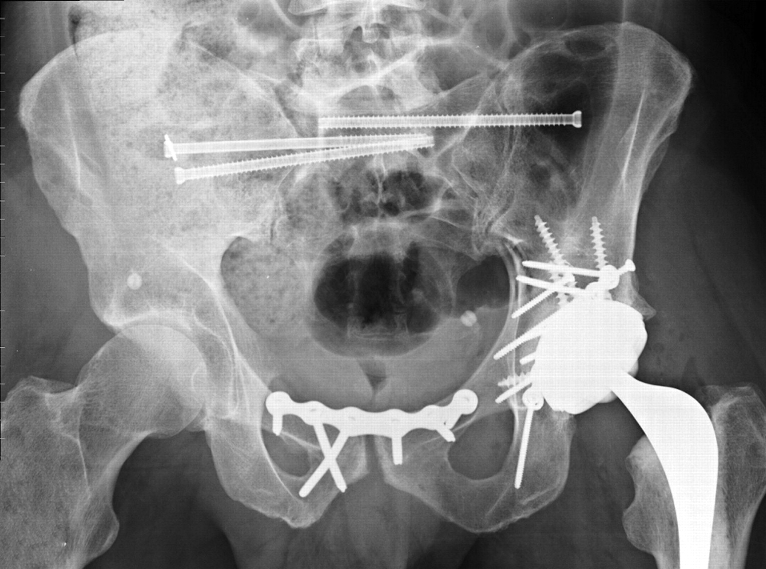 Survival of ceramic bearings in total hip replacement after high-energy ...