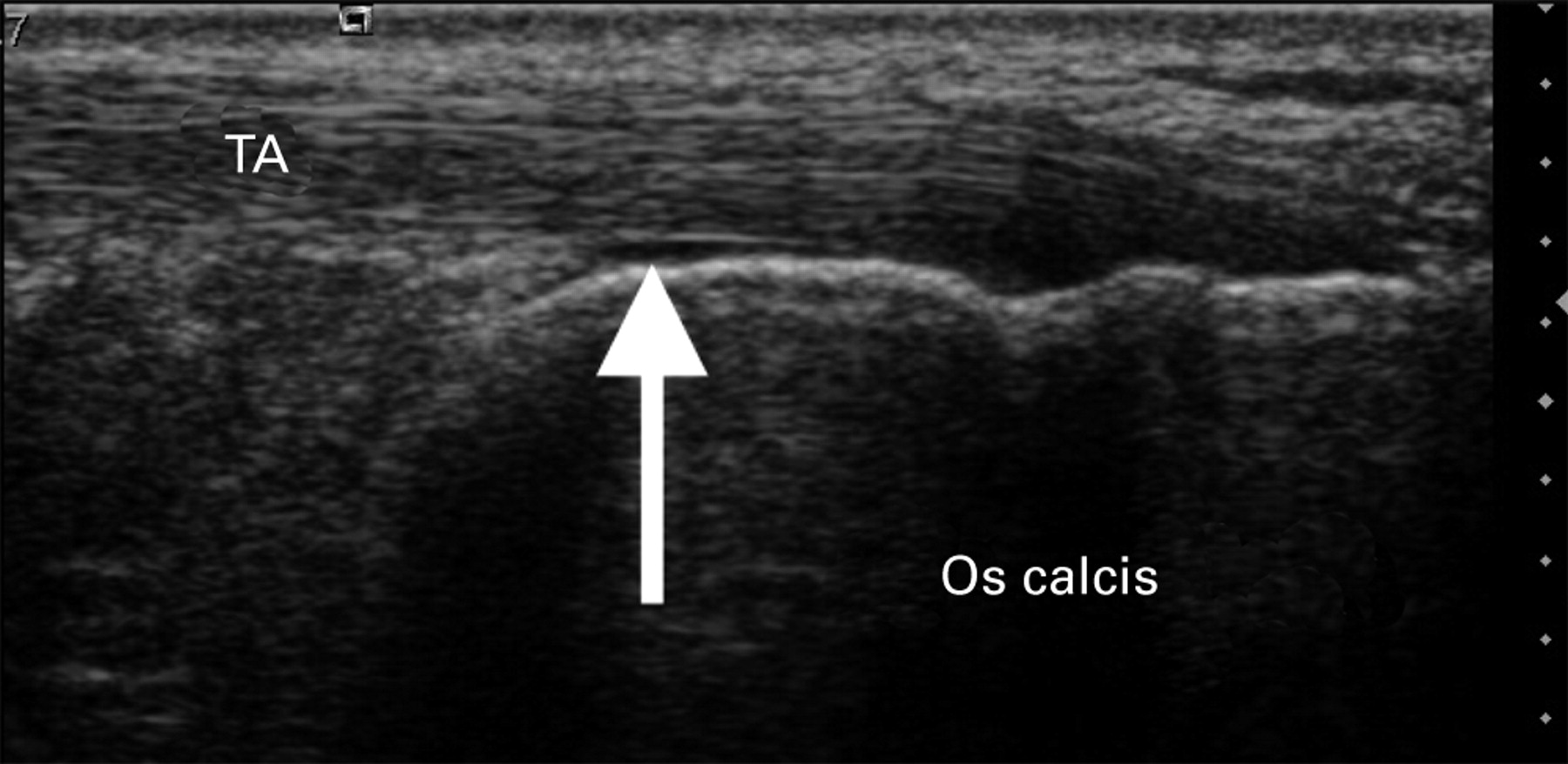 The Use Of Ultrasound In The Assessment And Treatment Of Achilles   23060 3 