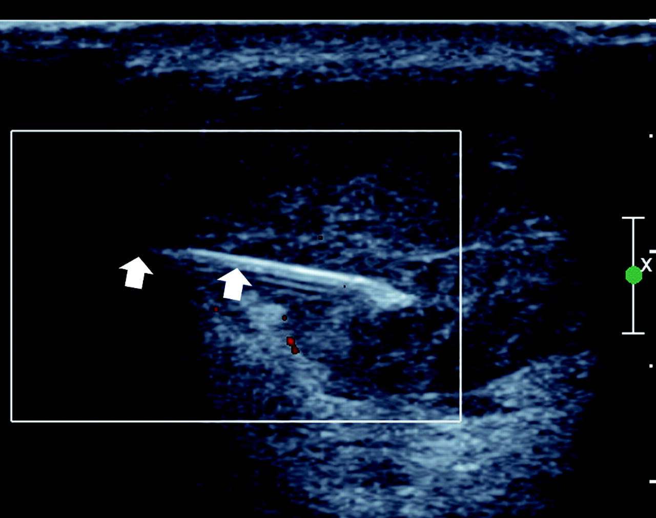 The use of ultrasound in the assessment and treatment of Achilles ...