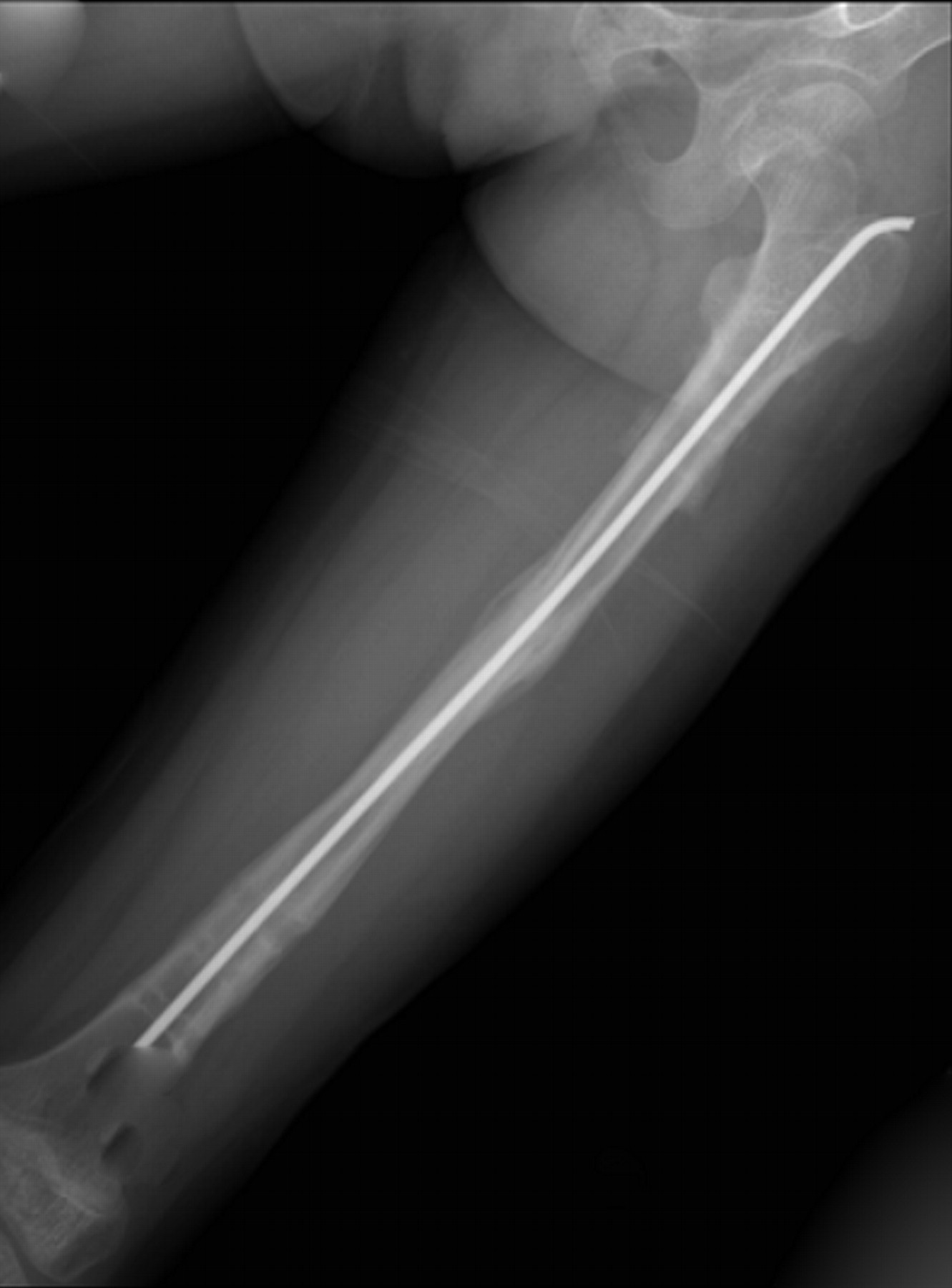 Femoral lengthening in achondroplasia | Bone & Joint