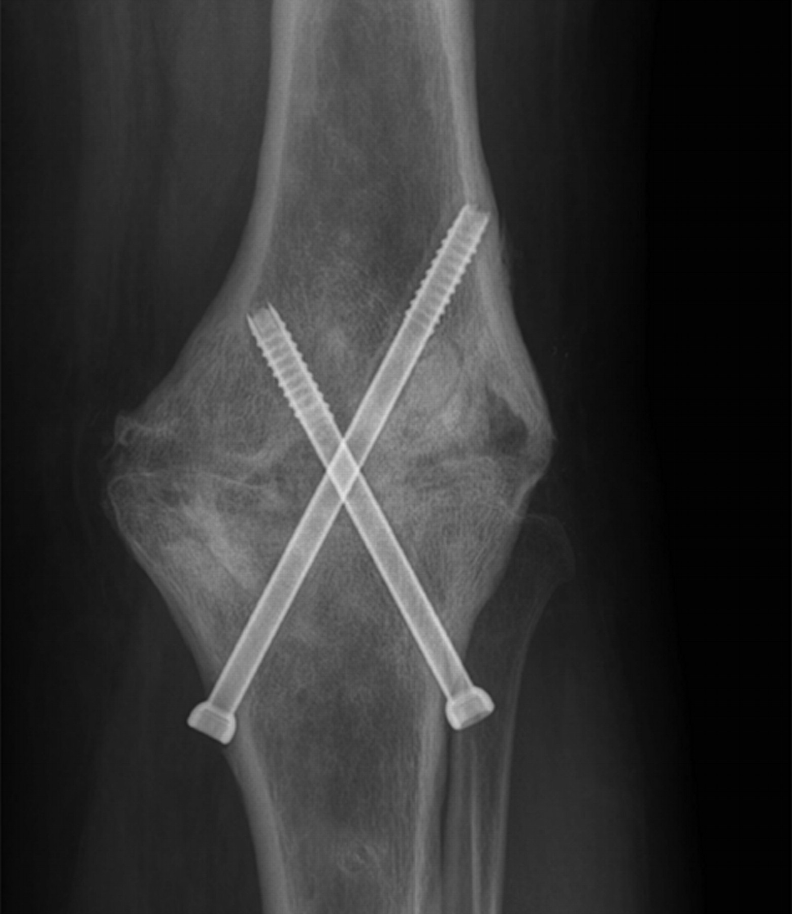 Arthrodesis Of The Knee Using Cannulated Screws | Bone & Joint