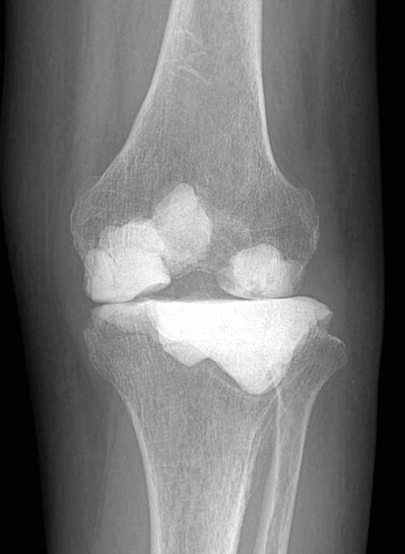 Arthrodesis of the knee using cannulated screws | Bone & Joint