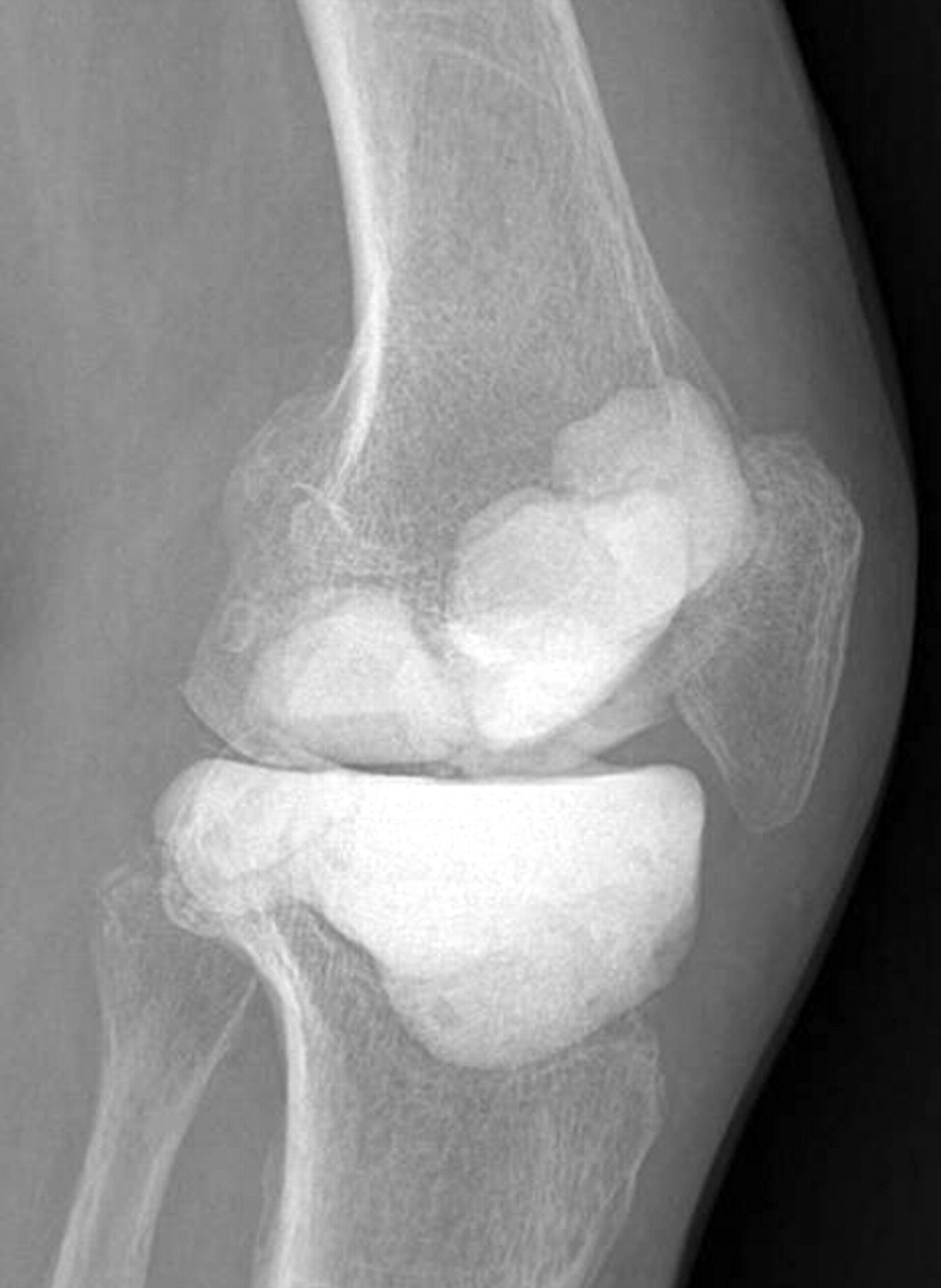 Arthrodesis Of The Knee Using Cannulated Screws 