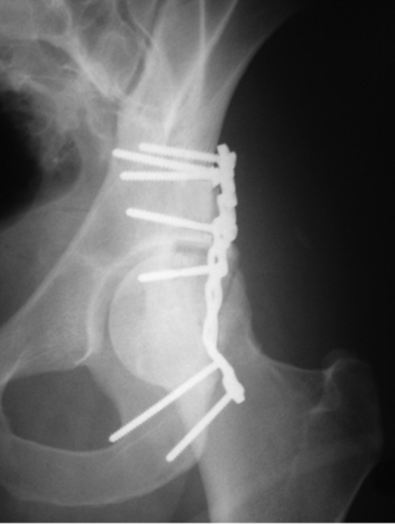 Early palsy of the sciatic nerve due to heterotopic ossification after ...