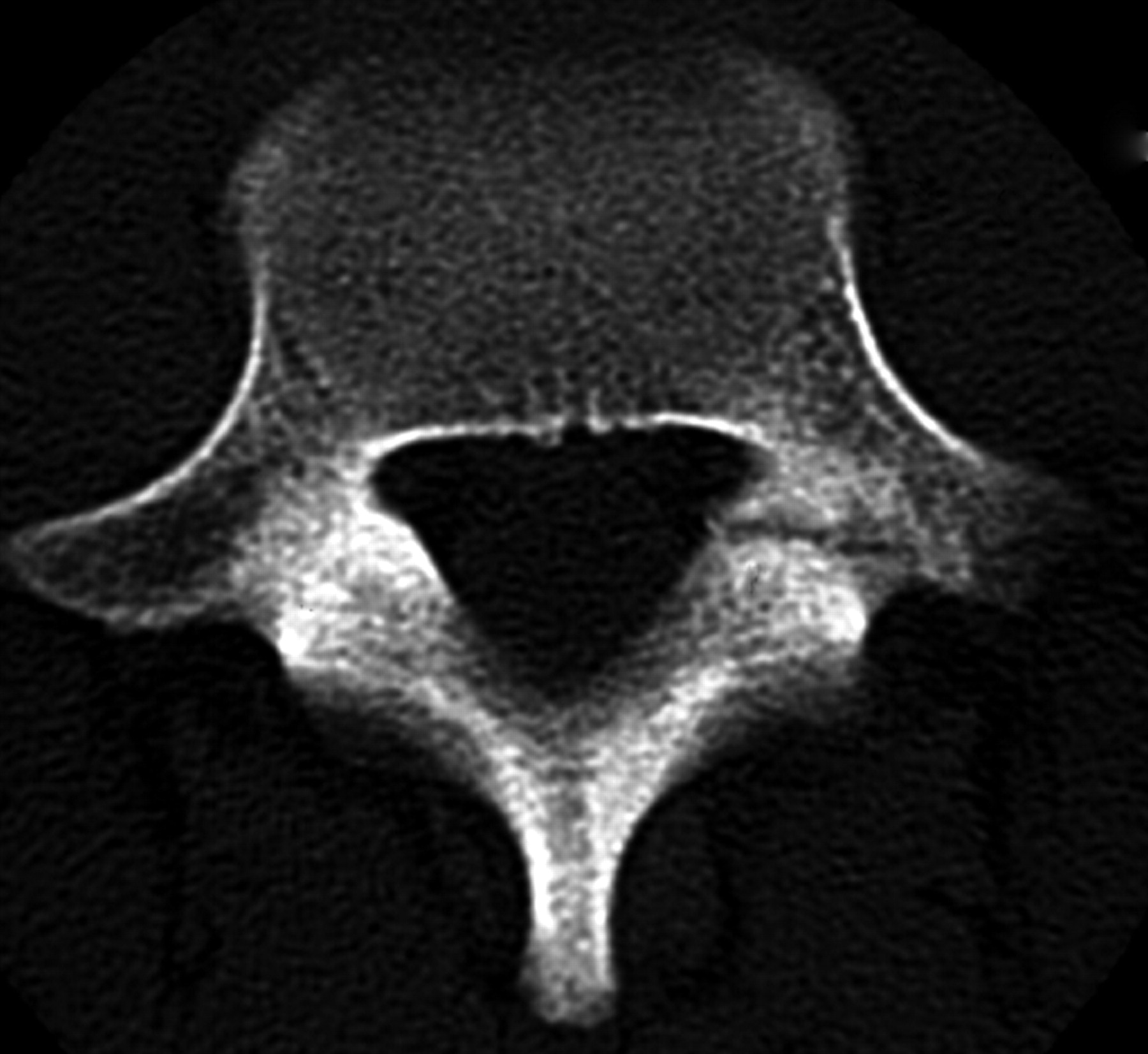 Conservative Treatment Of Lumbar Spondylolysis In Childhood And ...