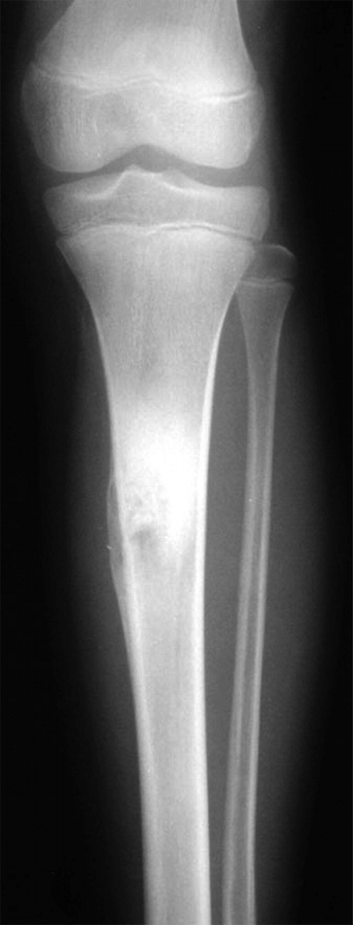 Fibular centralisation for the reconstruction of defects of the tibial ...