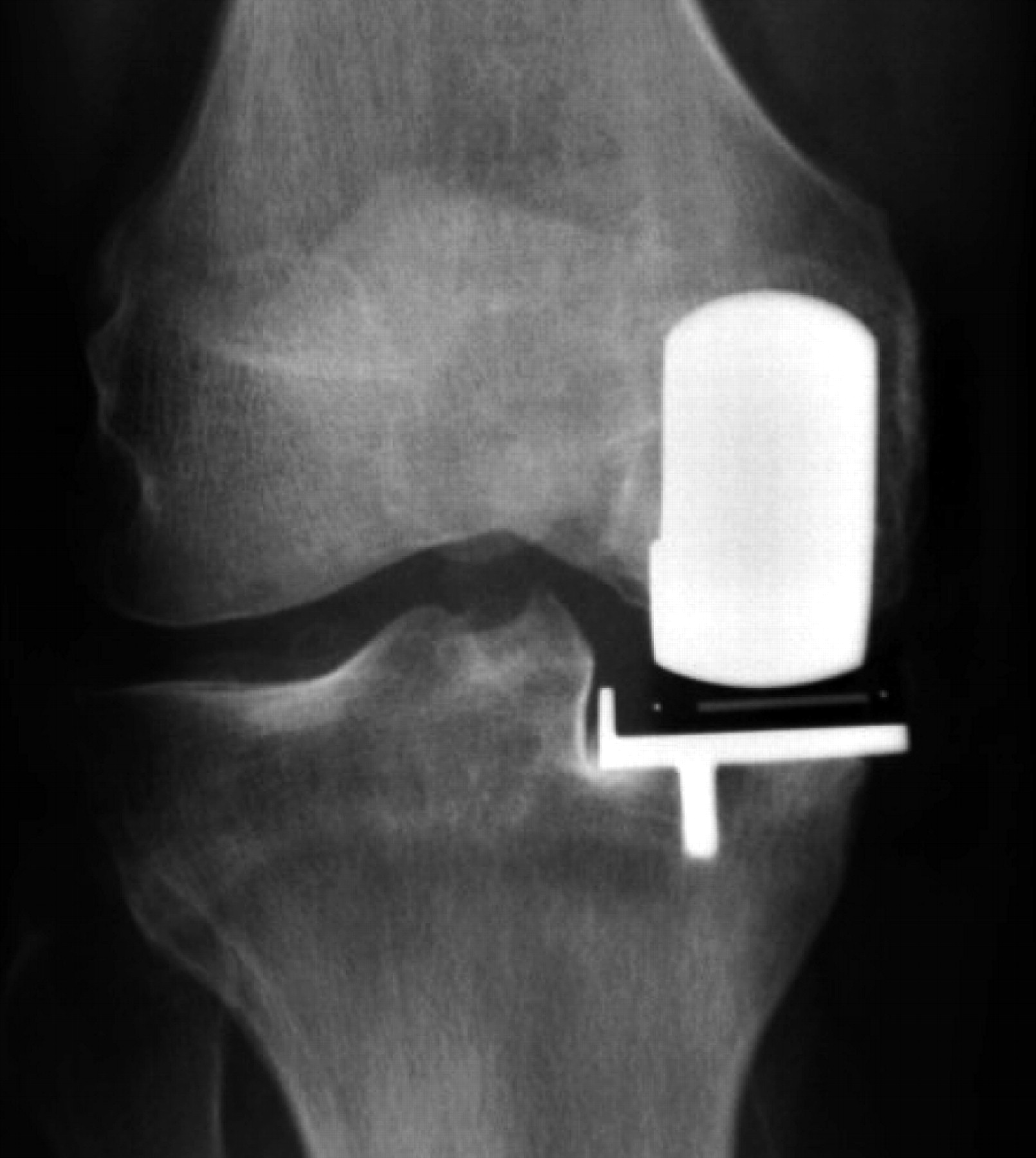 Cementless Oxford Unicompartmental Knee Replacement Shows Reduced Radiolucency At One Year 4218