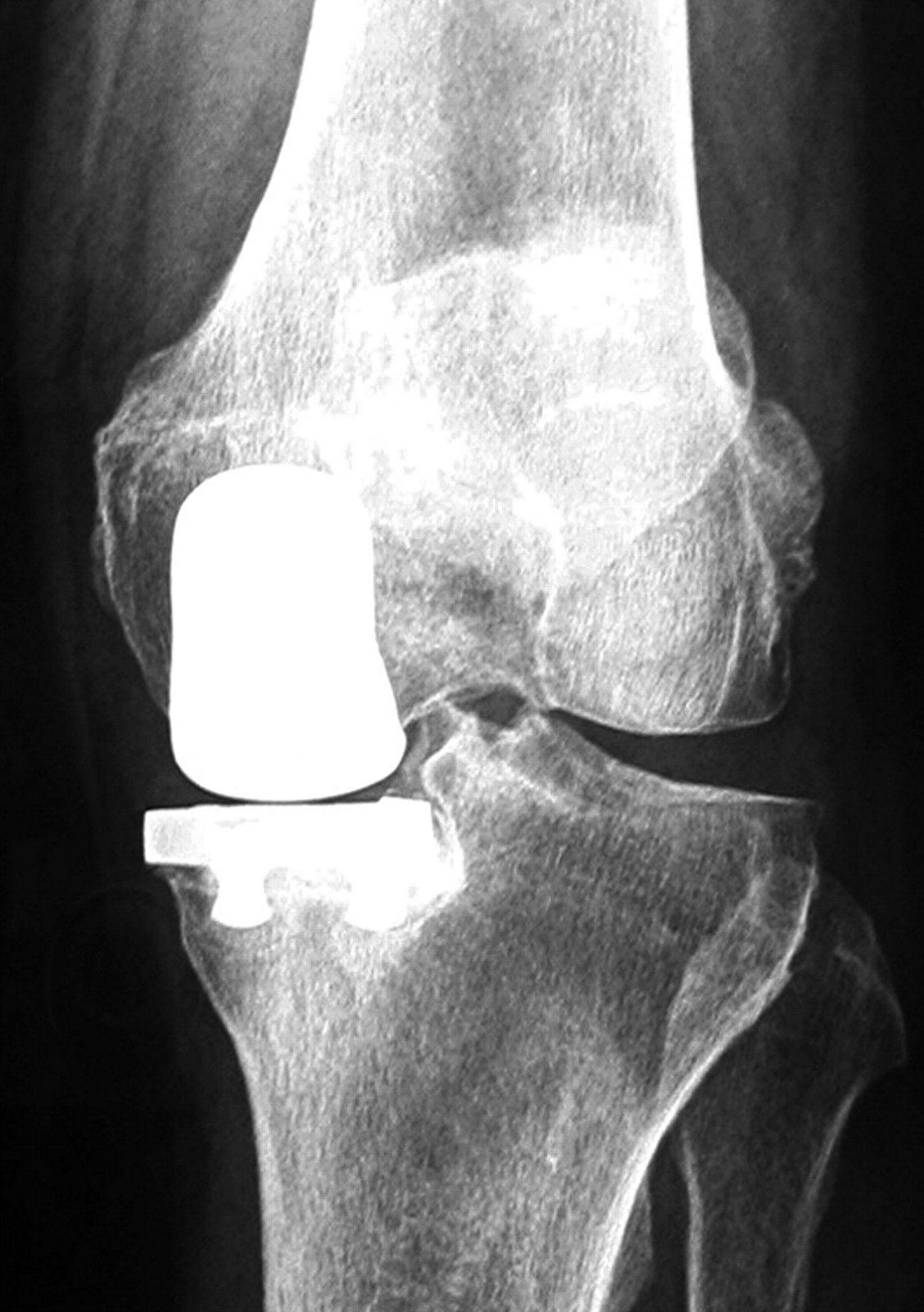 Medial Unicompartmental Knee Replacement In The Under-50s 