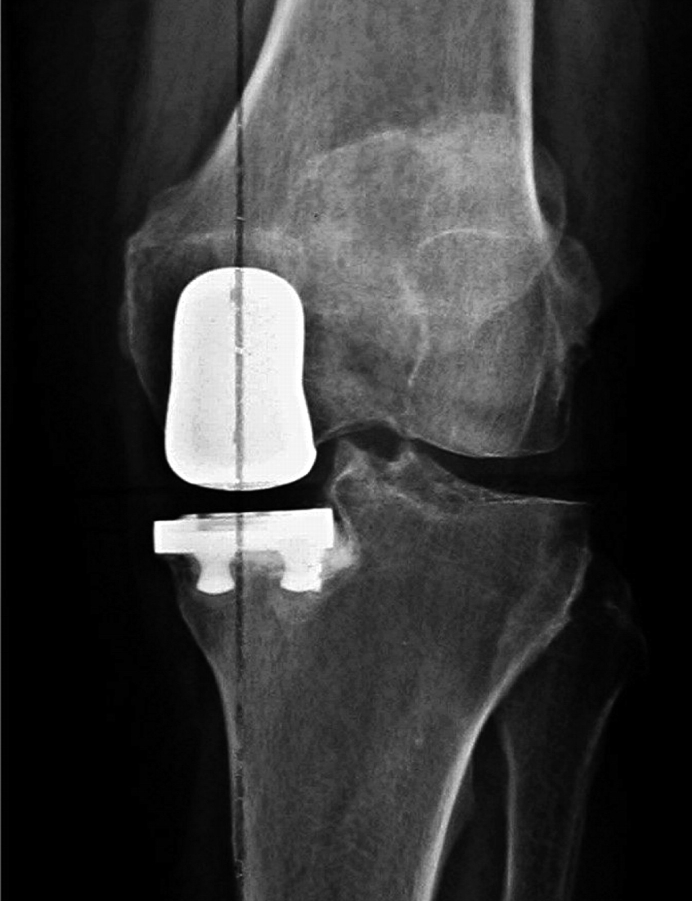 Medial unicompartmental knee replacement in the under-50s | Bone & Joint