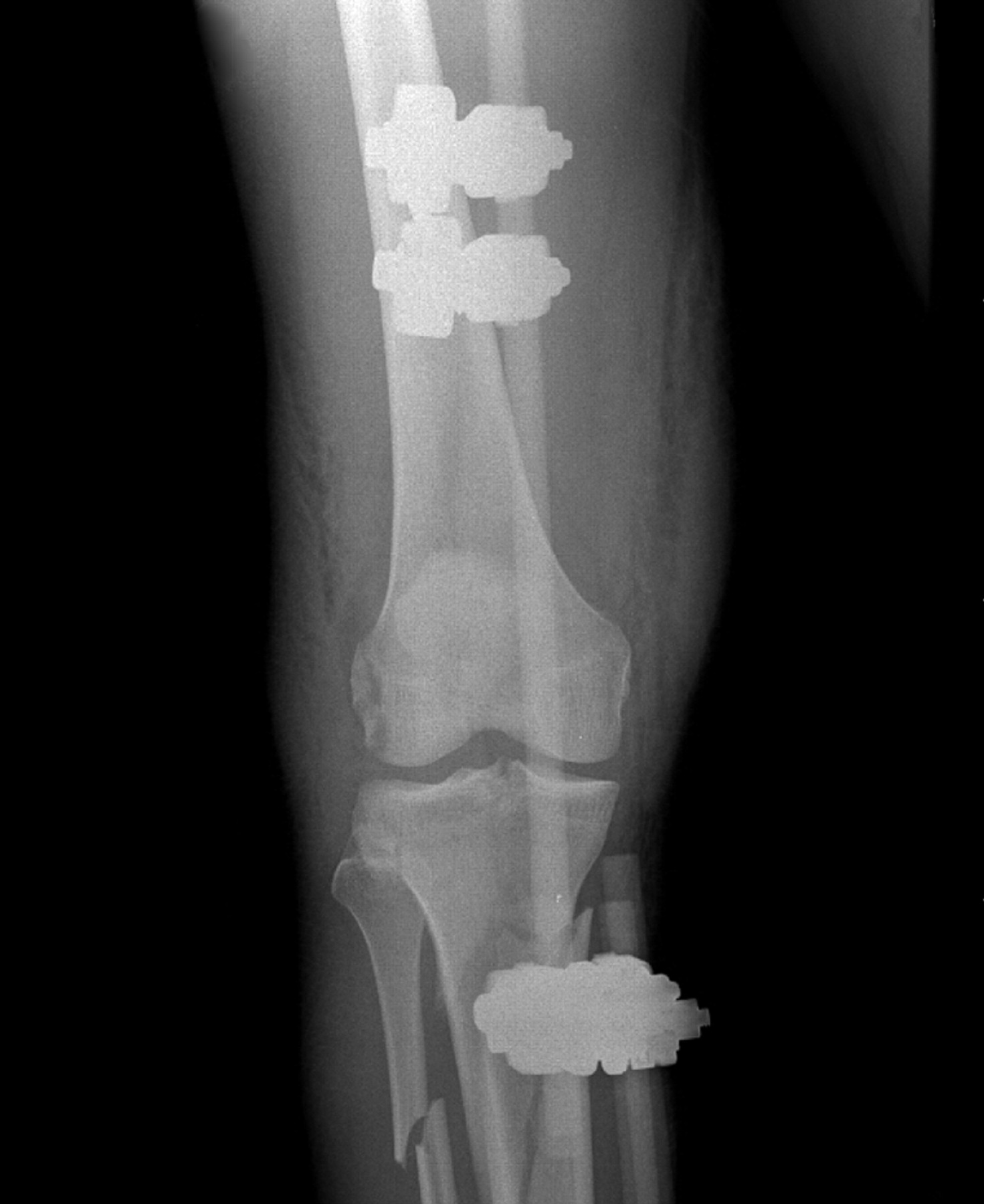 External Versus Internal Fixation For Bicondylar Tibi - vrogue.co