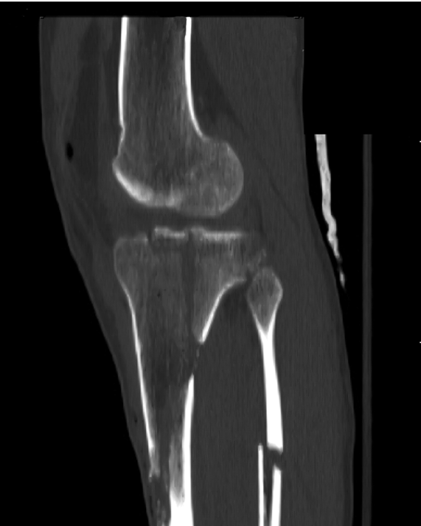 External Versus Internal Fixation For Bicondylar Tibi - vrogue.co