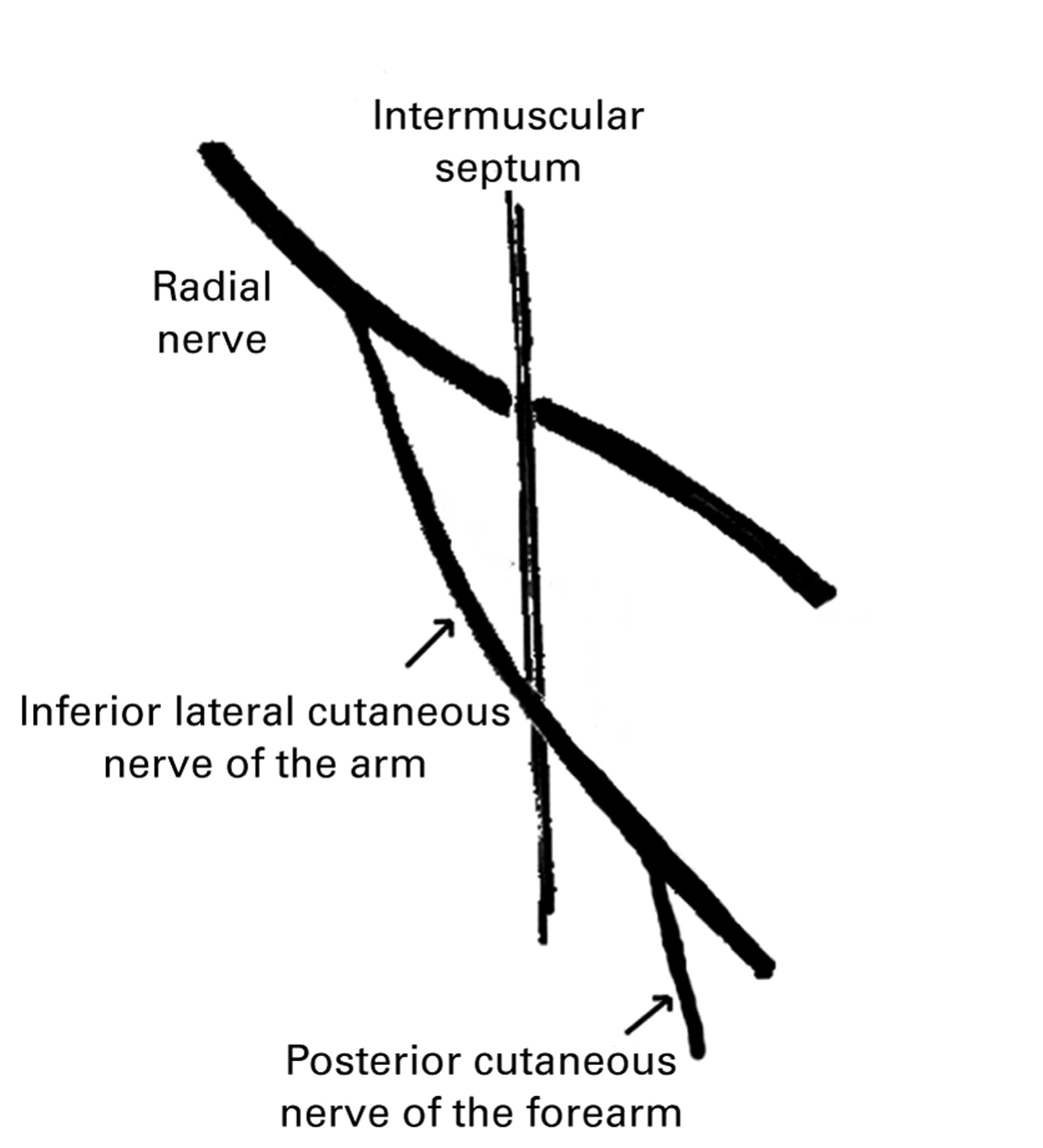 A lateral approach to the distal humerus following identification of ...