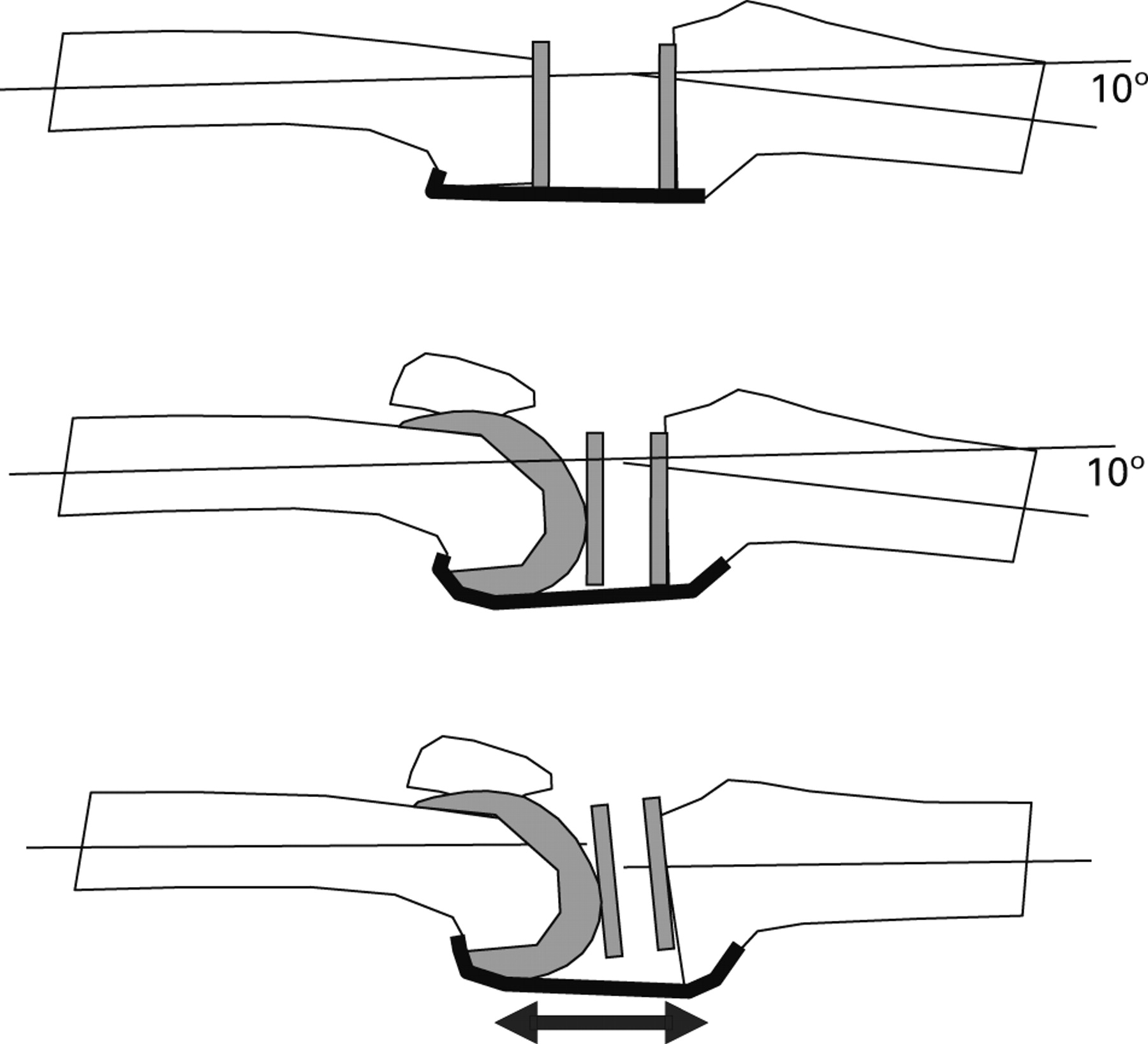 The Intra-operative Joint Gap In Cruciate-retaining Compared With ...