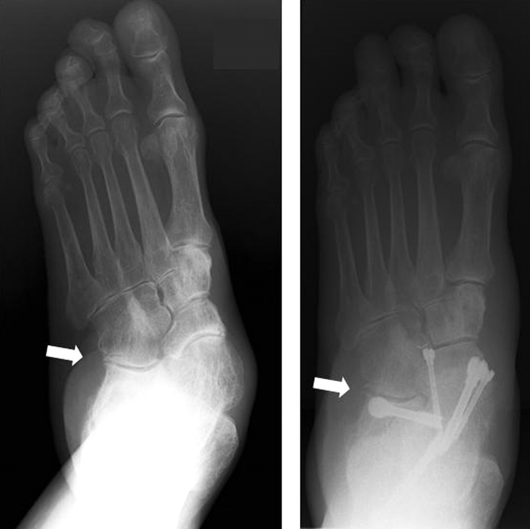 Subtalar and talonavicular arthrodesis through a single medial approach ...