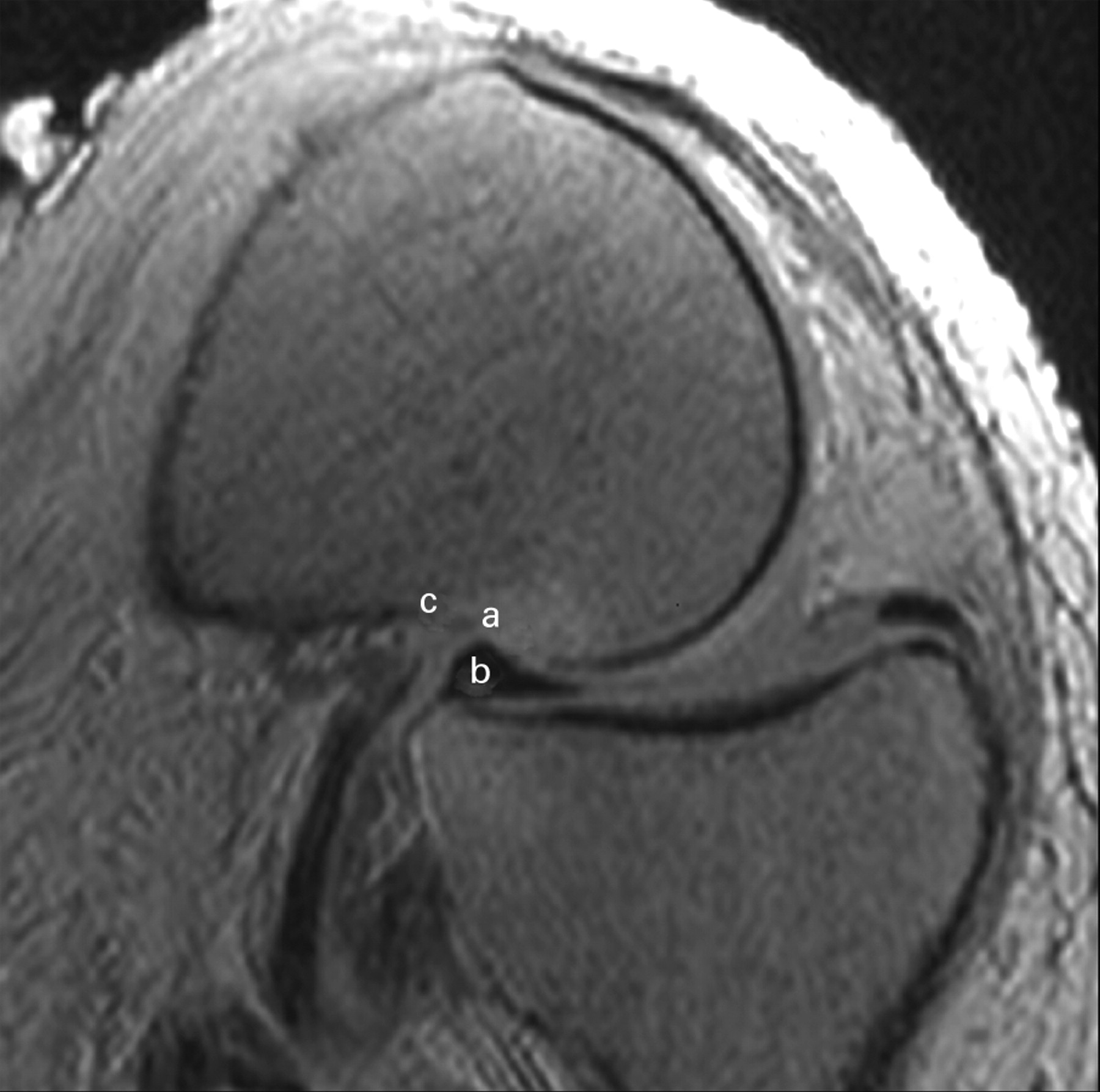 The knee in full flexion | Bone & Joint