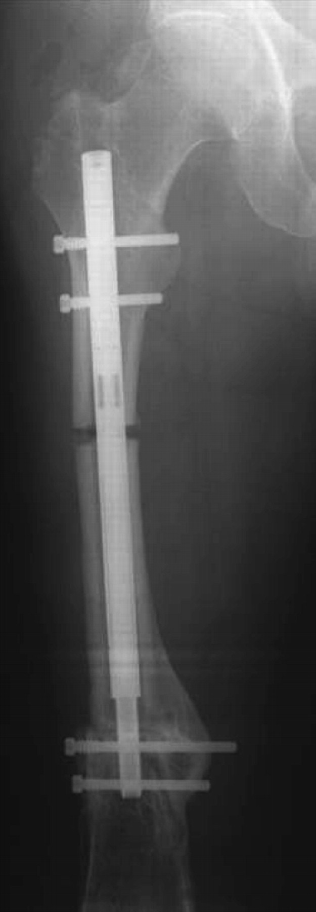 Femoral Lengthening With The Intramedullary Skeletal Kinetic Distractor ...