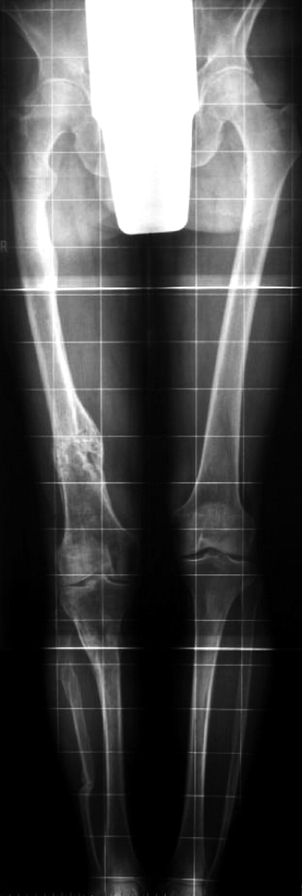 Femoral Lengthening With The Intramedullary Skeletal Kinetic Distractor ...