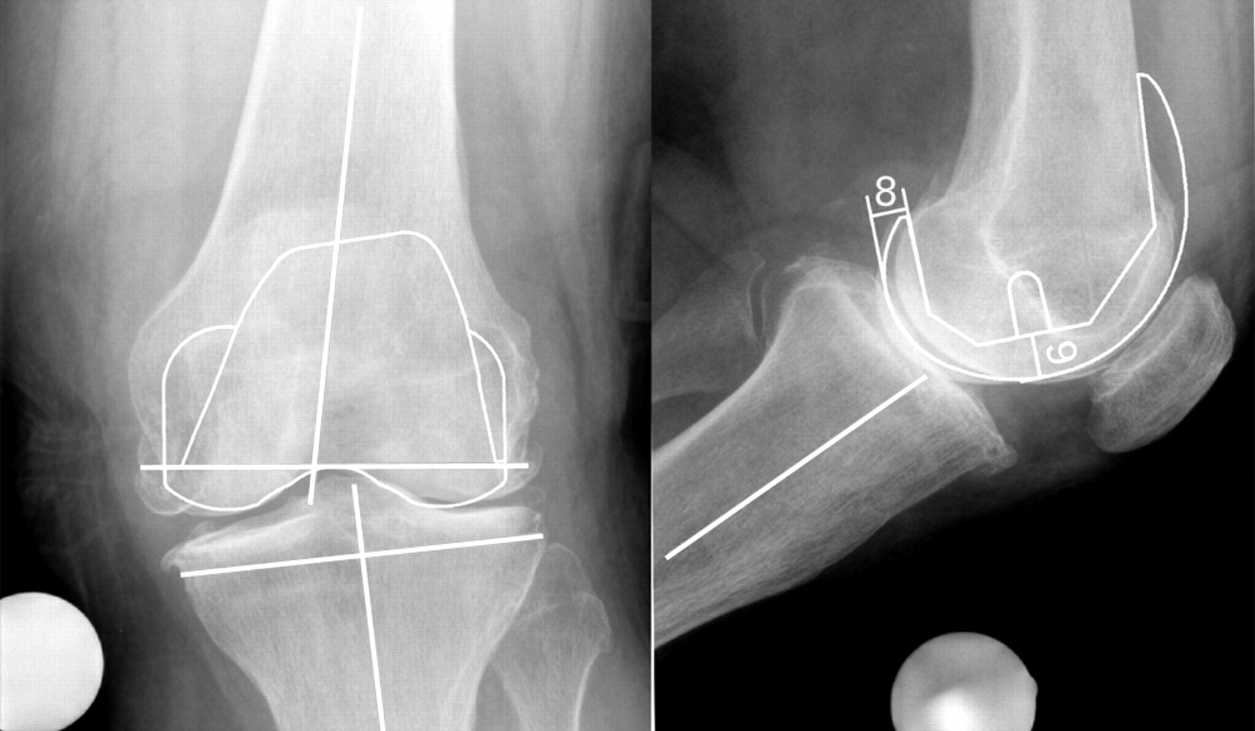 The reliability and accuracy of digital templating in total knee ...