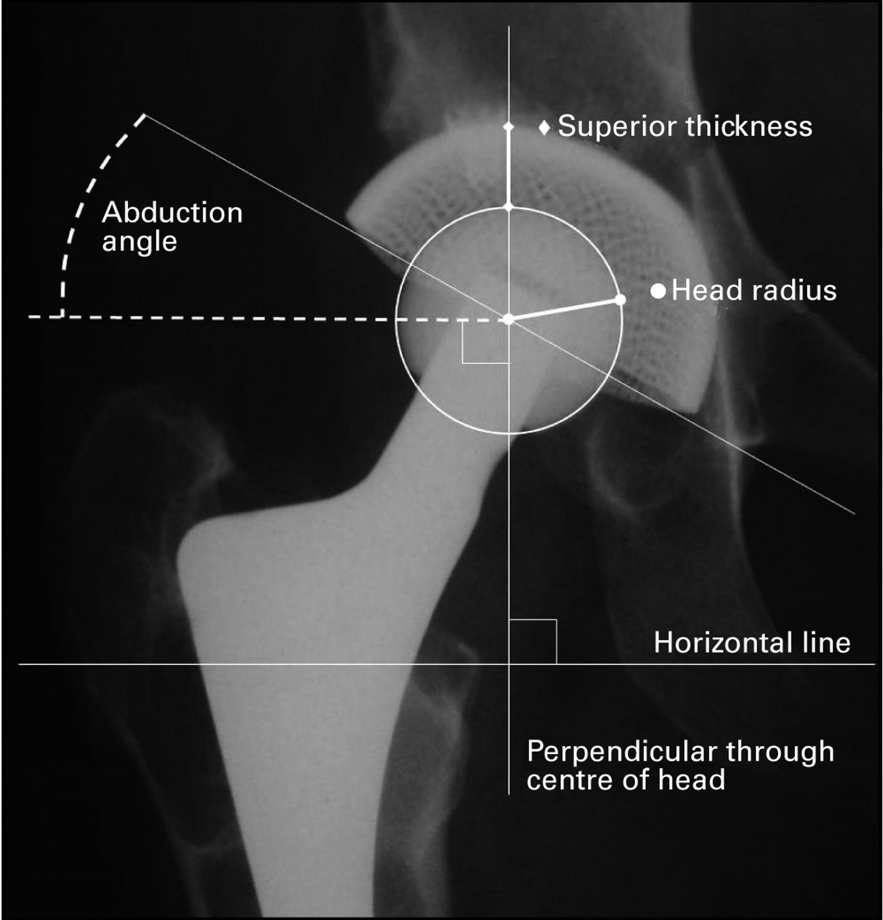 The Morscher Press Fit acetabular component | Bone & Joint