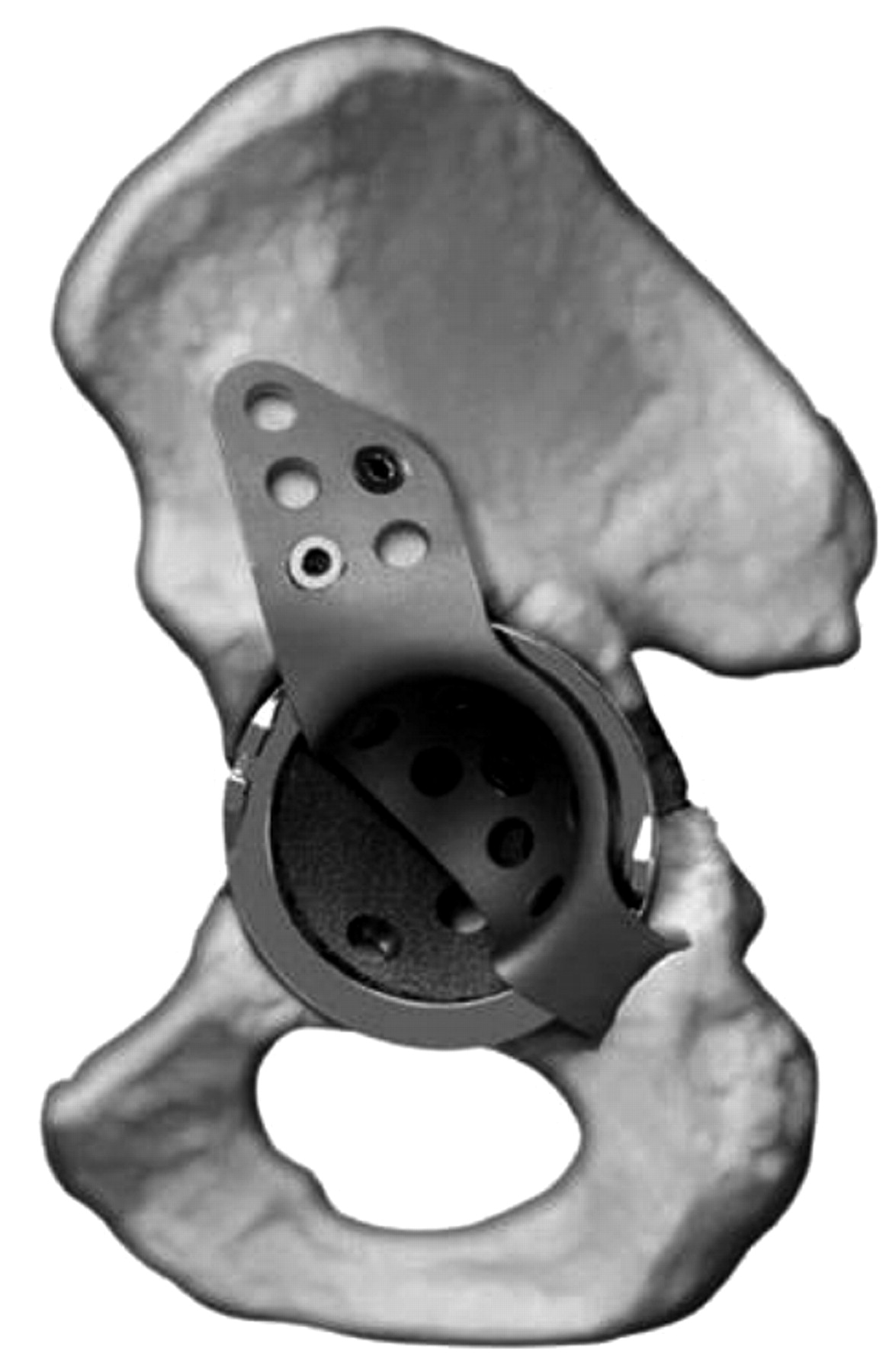 Acetabular Revision Using An Anti-protrusion (ilio-ischial) Cage And ...