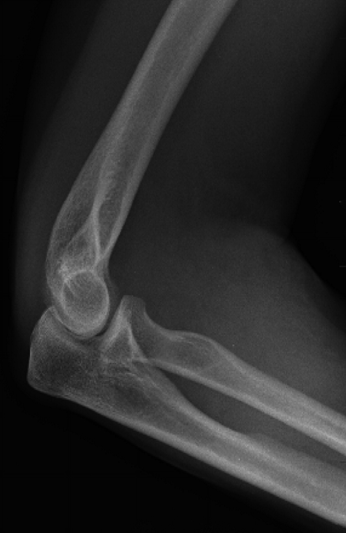 Thrombosis of the brachial artery after closed dislocation of the elbow ...