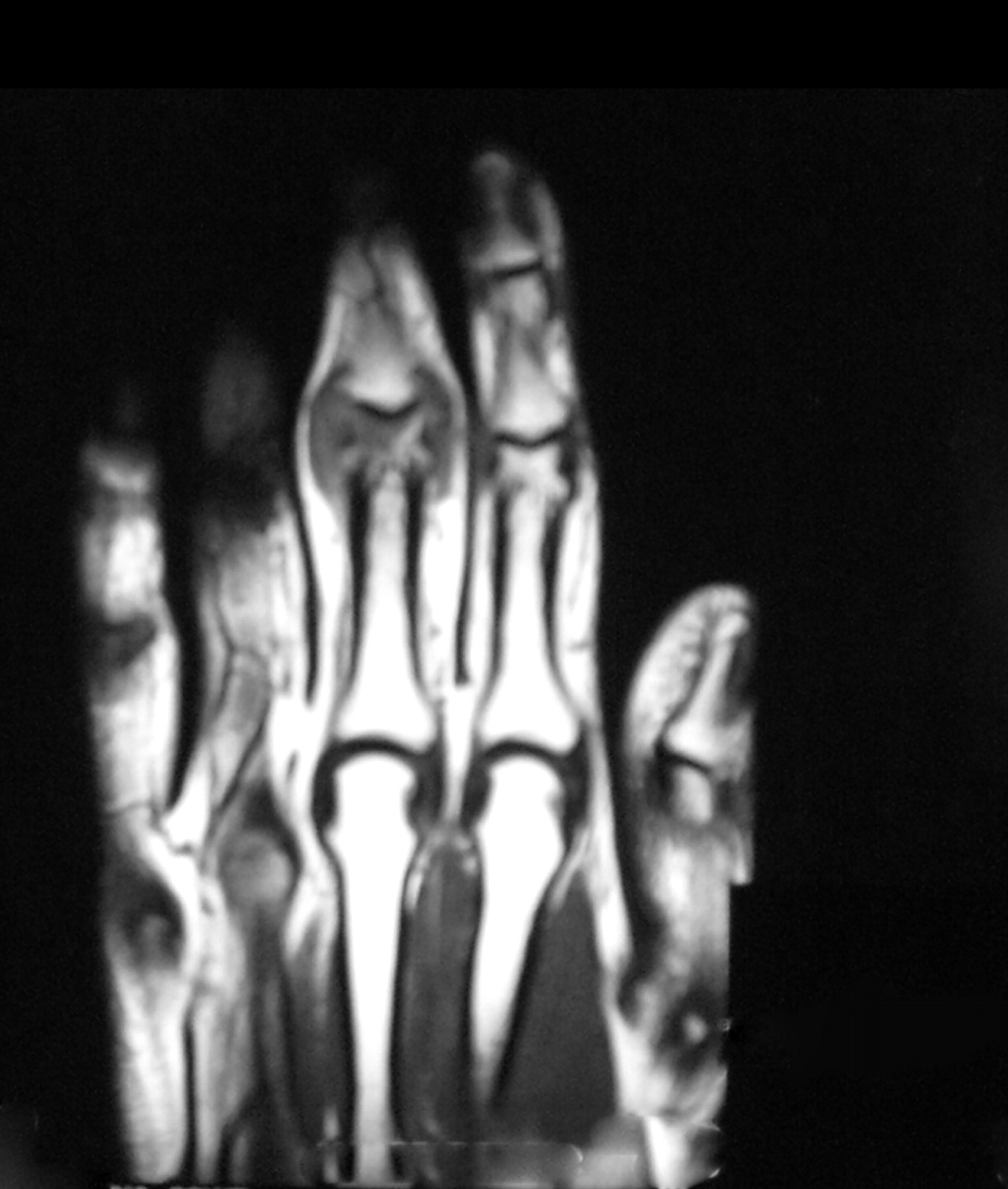 Tuberculosis Of The Hand | Bone & Joint