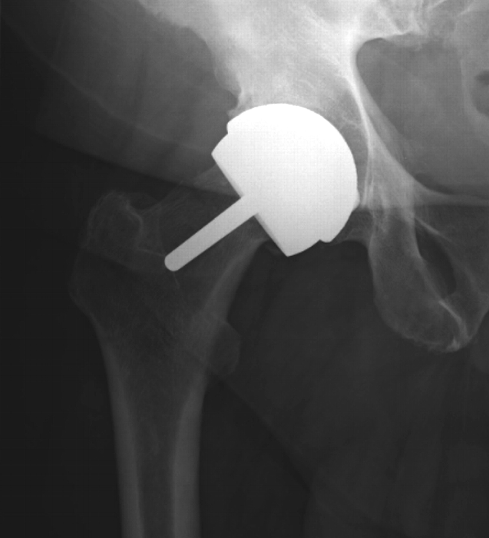 Intracapsular Fracture Of The Proximal Femur After Hip Resurfacing