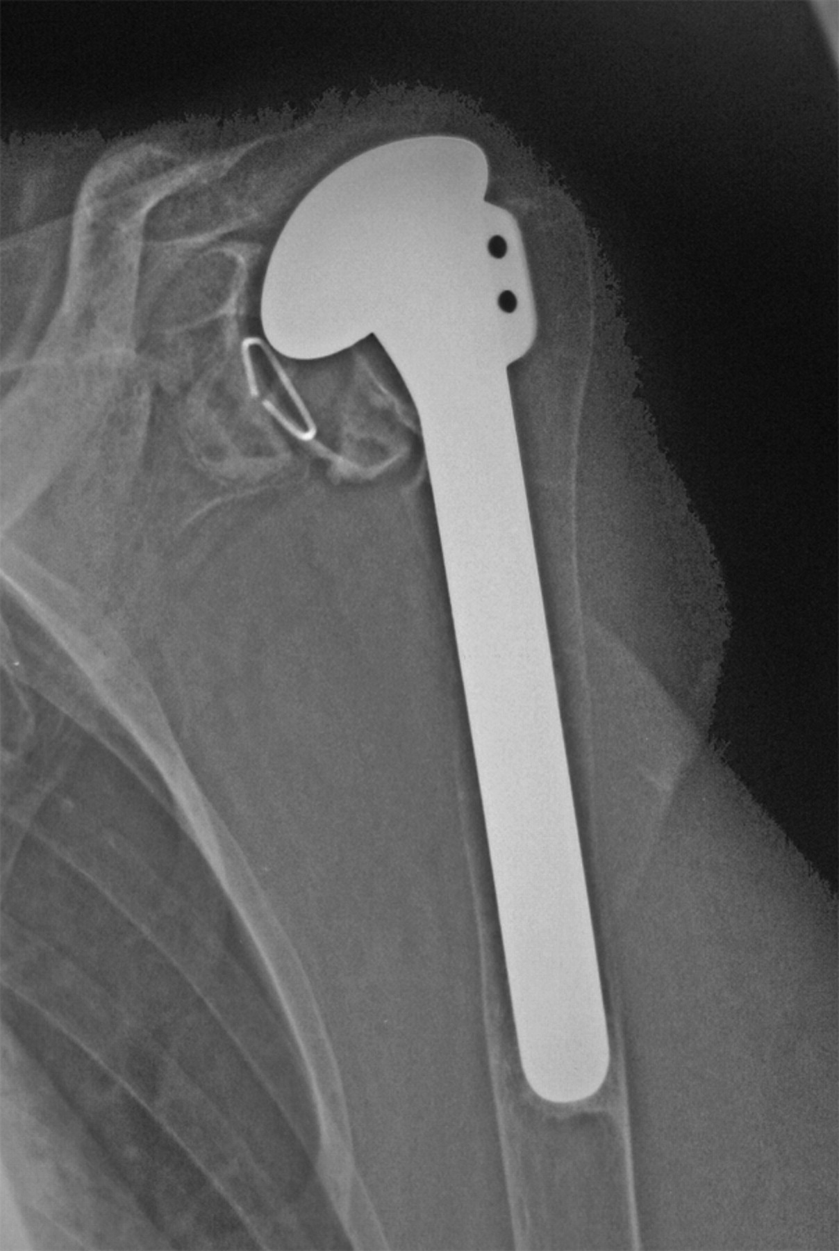 Total Shoulder Replacement In Rheumatoid Disease Bone And Joint