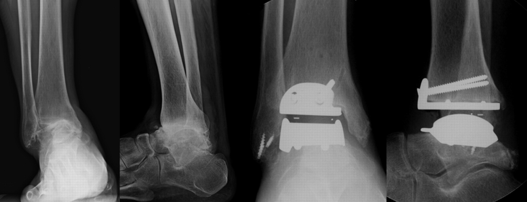 Total Ankle Replacement In Moderate To Severe Varus Deformity Of The Ankle Bone Joint